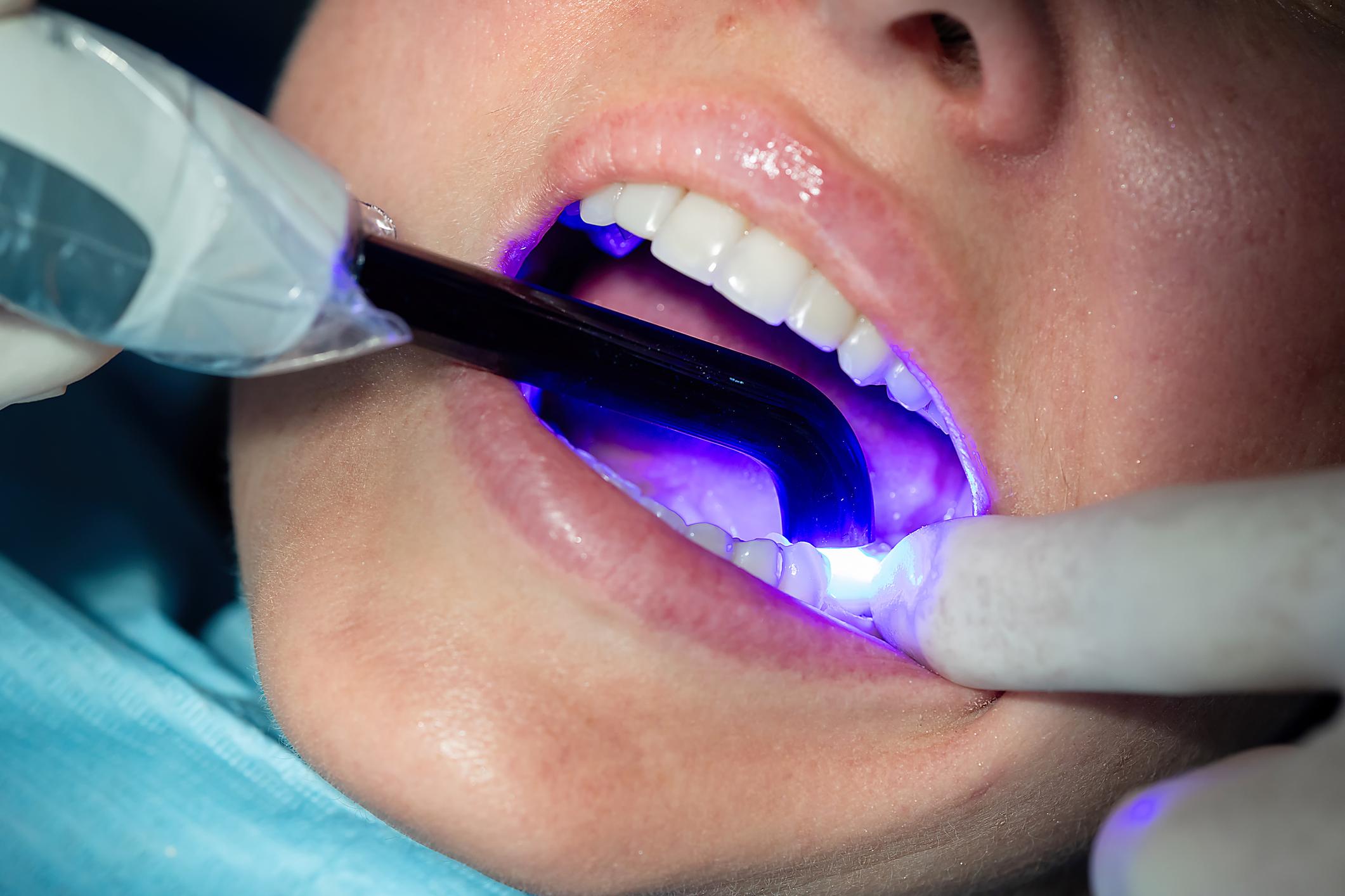 fissure-sealants-logan